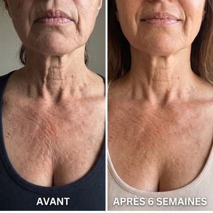 Avant / après 6 semaines — décolleté lissé
